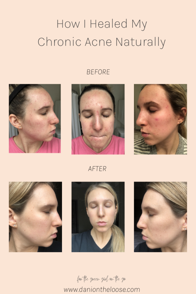 How I Healed My Chronic Acne Naturally
